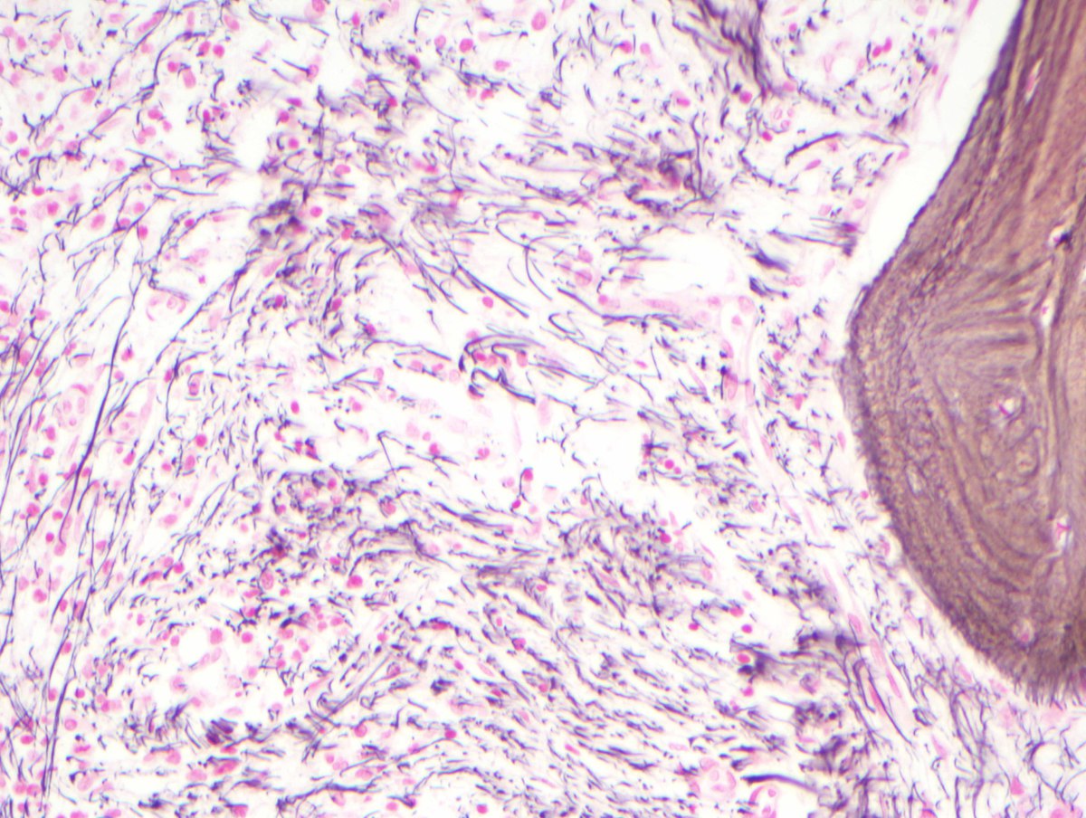 F) Bone marrow reticulin fibrosis 4+/4+ (MF-3) (reticulin, 400x)
